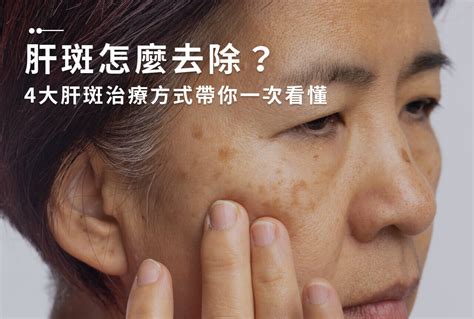 臉頰的斑|曬斑、肝斑、老人斑，我是哪種斑？肝斑就是肝不好？。